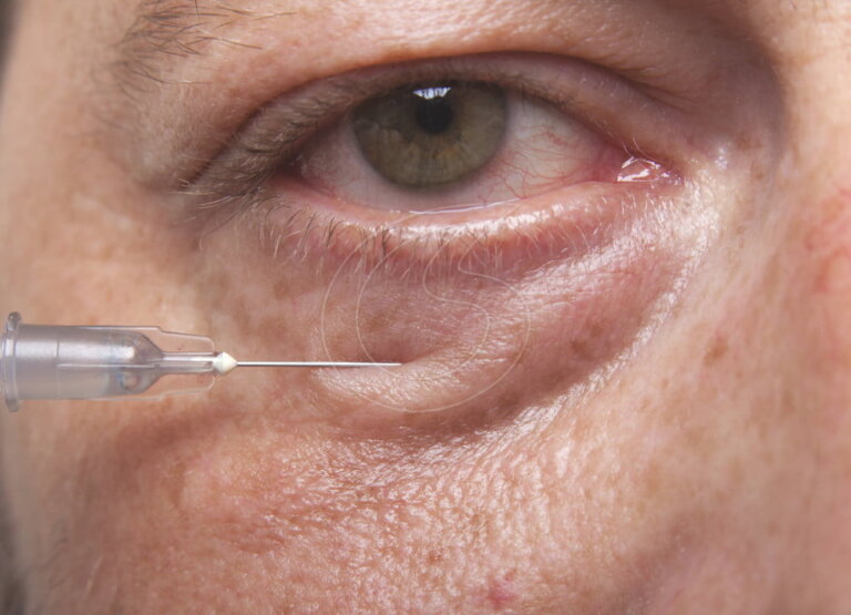 Acidul hialuronic - vedeta intervenţiilor antirid