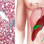 Cele mai bune tratamente naturiste pentru afectiunile hepatice