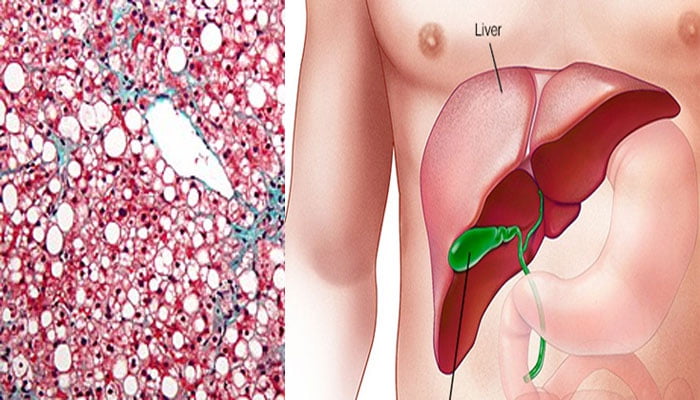 Cele mai bune tratamente naturiste pentru afectiunile hepatice