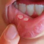 Afte bucale: cauze posibile si solutii din natura