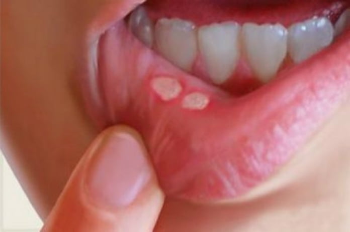 Afte bucale: cauze posibile si solutii din natura