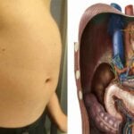 Învaţă cum să scapi rapid de balonare