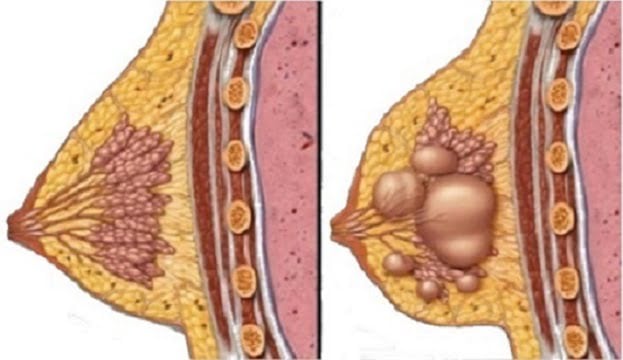 5 simptome atipice ale cancerului mamar