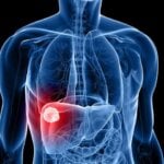 Ce este proteina C reactiva?