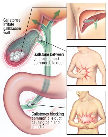 cholecystitis