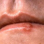 Cum să scapi de herpes simplu şi rapid