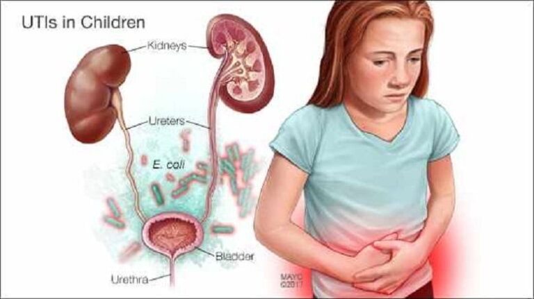 Infectia tractului urinar (ITU)