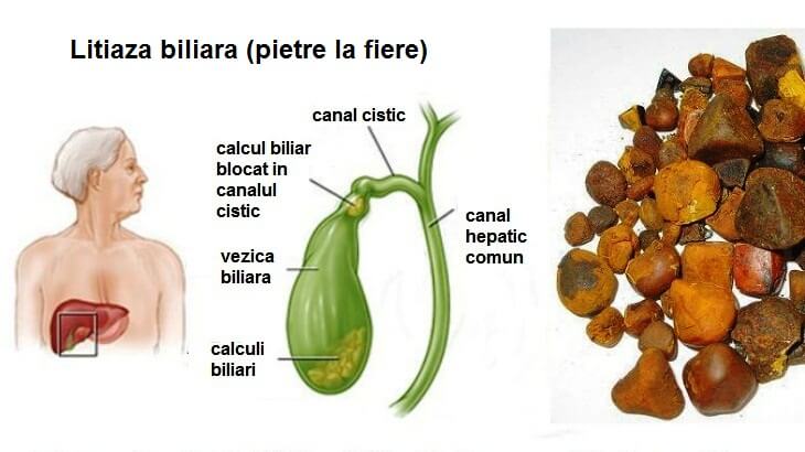 litiaza biliara