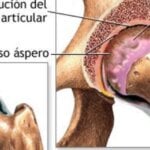 Osteoartroza - Cauze