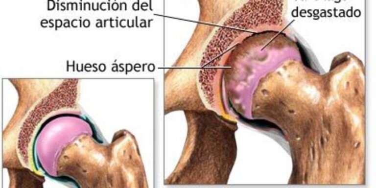 Osteoartroza - Cauze