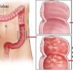 10 remedii naturiste bune pentru COLITĂ